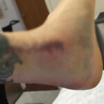 Linkin Park's Chester Bennington Shows Off His Grisly Wounds From Ankle Surgery
