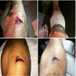 Animals As Leaders Share Photos Of Grisly Leg Injury Suffered Onstage