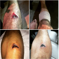 Animals As Leaders Share Photos Of Grisly Leg Injury Suffered Onstage