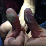 Converge Drummer Ben Koller Shows Off The Side Effect Of A Blistering Live Performance