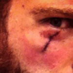Black Crown Initiate Vocalist Has Skin Cancer Removed