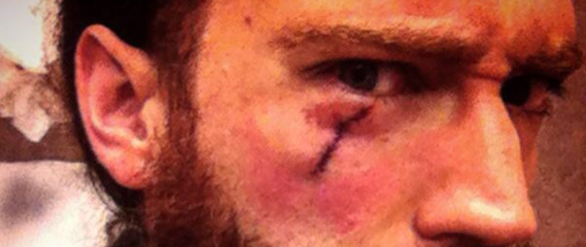 Black Crown Initiate Vocalist Has Skin Cancer Removed