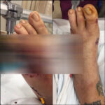 The Ghost Inside's Guitarist Lost Two Toes In Fatal Crash, Shares Grisly Before & After Photo