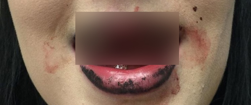 Gofundme & Benefit Shirt Launched For Woman Who Lost Four Teeth At 2017 'Sound And Fury' Fest