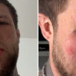 Slaughter To Prevail's Alex Terrible Shows Off Gnarly Bare Knuckle Sparring Injury