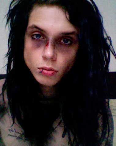 Andy Biersack's Broken Nose