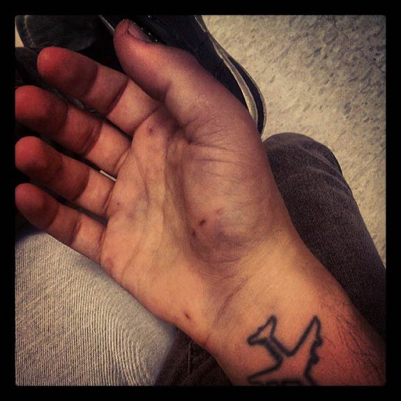 Ben Weinman's Broken Hand