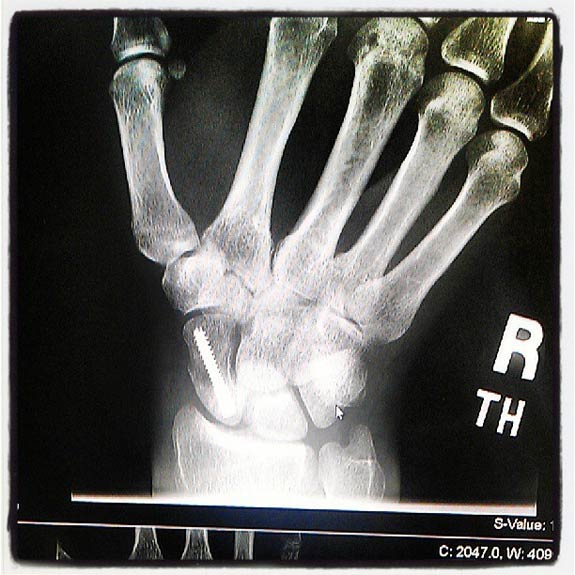 Ben Weinman's Surgically Repaired Appendage