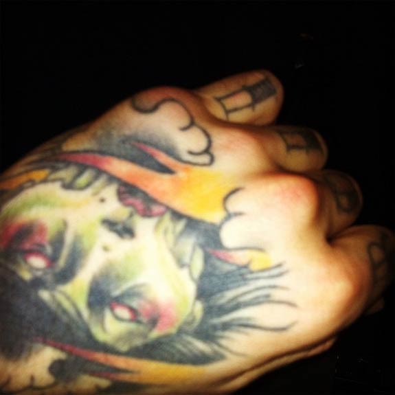 Jona Weinhofen's broken hand