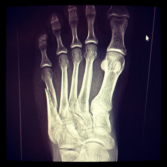 Mastodon's Brent Hinds' Broken Foot