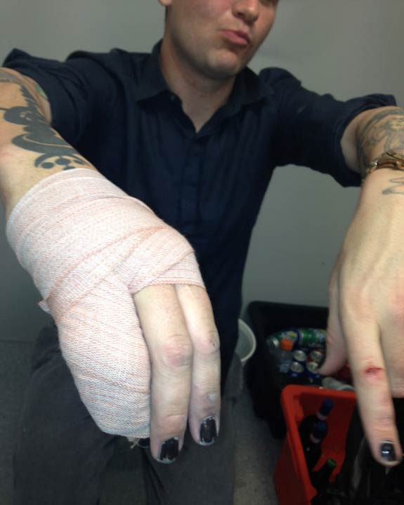 Mikey Cox's Broken Fingers