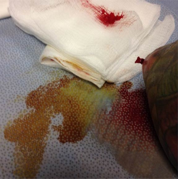 Mitch Lucker's Broken Elbow