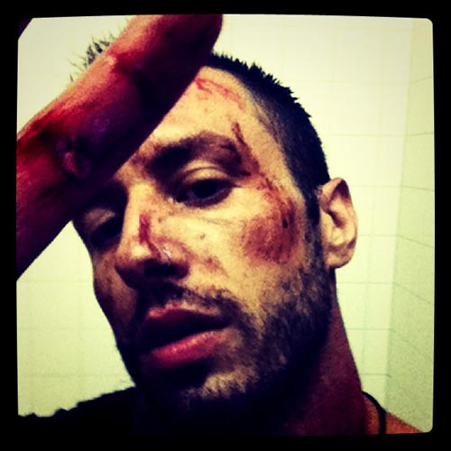 The Dillinger Escape Plan's Greg Puciato Post Austrian Show Injury